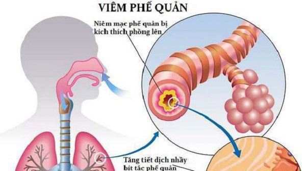 Phế quản là bộ phận quan trọng trong hệ thống hô hấp, giúp thực hiện chức năng thông khí của cơ thể.