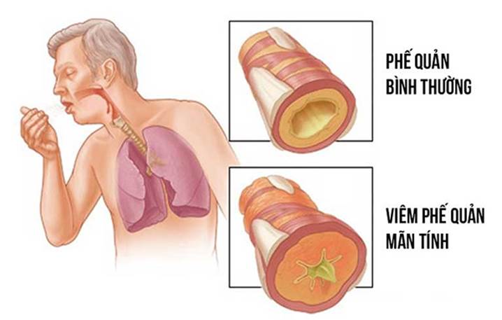 Bệnh viêm phế quản mãn tính: Những điều cần biết!