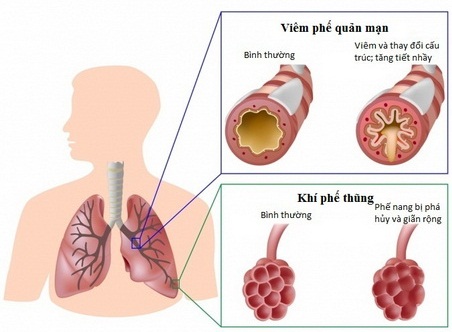 Bí quyết để có hệ hô hấp khỏe mạnh giúp phòng ngừa bệnh phổi tắc nghẽn mãn tính CODP