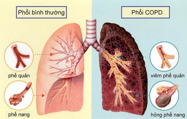 Bệnh phổi tắc nghẽn mạn tính - Khám chữa bệnh, phổ biến kiến thức ...