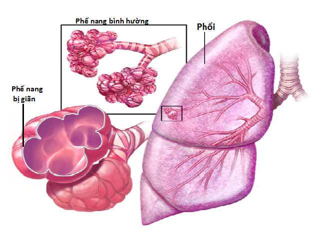 Khí phế thũng