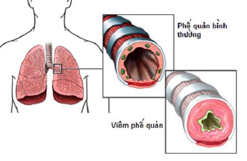 Phế quản bị viêm sẽ gây cản trở lưu thông của không khí