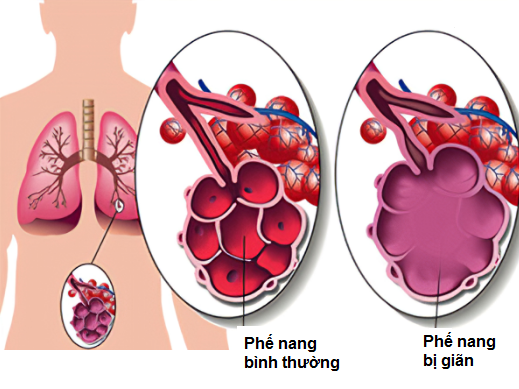 Giãn phế nang làm làm khả năng trao đổi khí bị sụt giảm