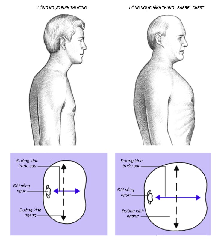 Lồng ngực biến dạng hình thùng cần nghi ngờ bệnh khí phế thũng