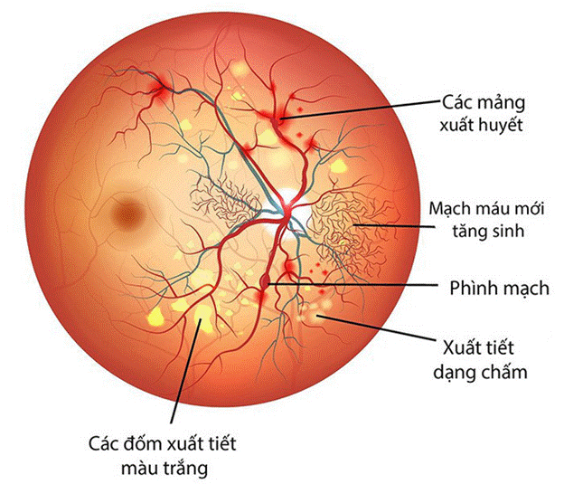 Hình ảnh soi đáy mắt bệnh võng mạc tiểu đường