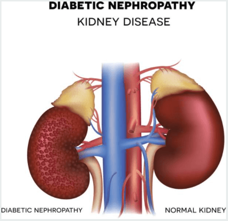  Bệnh thận đái tháo đường là gì?