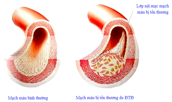 Cơ chế gây biến chứng tim mạch ở bệnh nhân tiểu đường