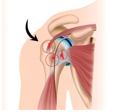Tổn thương gân ở người bệnh tiểu đường có thể gây rách chóp xoay vùng vai