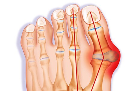 Triệu chứng bệnh gút - làm thế nào để cơn gút cấp không quay trở lại?