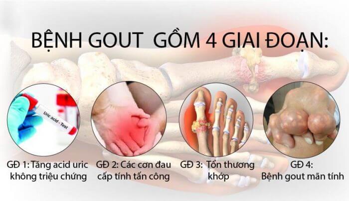 4 giai đoạn chính của bệnh gút