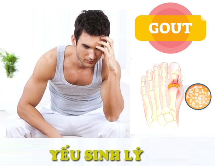 Bạn có thể bị yếu sinh lý vì bệnh gút!