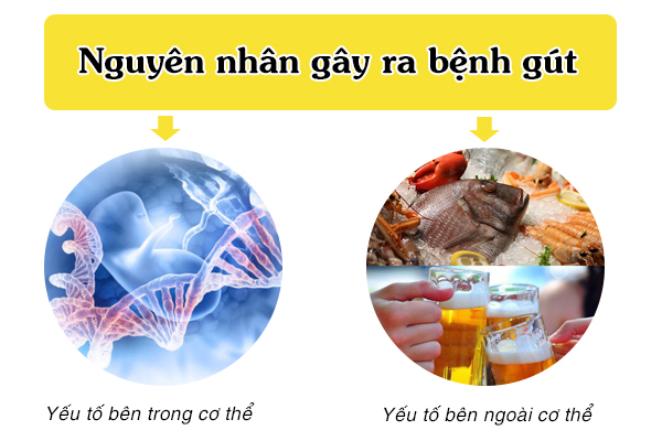 Bệnh gút do những nguyên nhân nào gây ra?