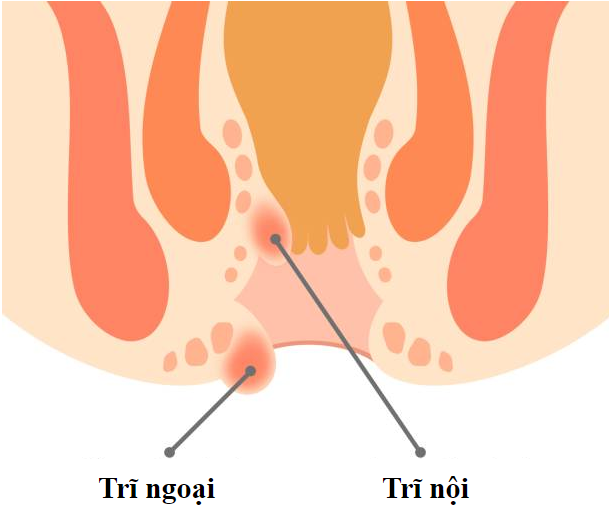 Bệnh trĩ được phân loại như thế nào?