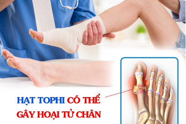 Hạt tophi có thể gây hoại tử chân