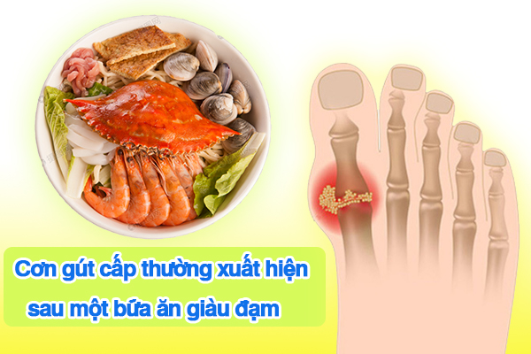 Cơn gút cấp thường xuất hiện sau một bữa ăn giàu đạm