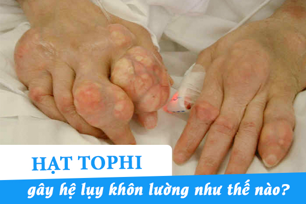 Hạt tophi gây hệ lụy khôn lường như thế nào?