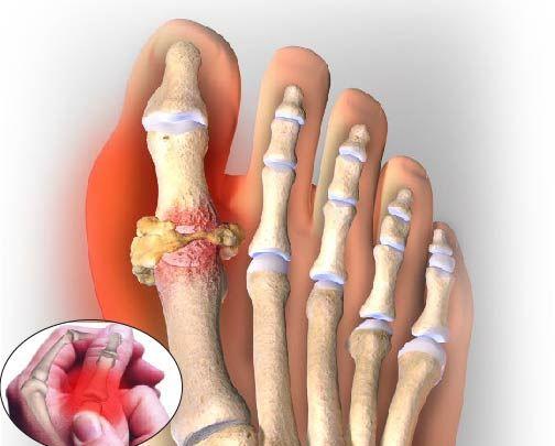 5 sai lầm thường gặp khiến bệnh Gout ngày càng trở nên tồi tệ