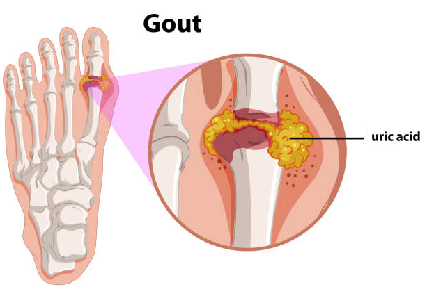 Acid uric tăng cao trong thời gian dài sẽ phá hủy khớp của bạn