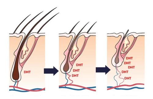 DHT tác động vào nang tóc gây tình trạng rụng tóc nhiều