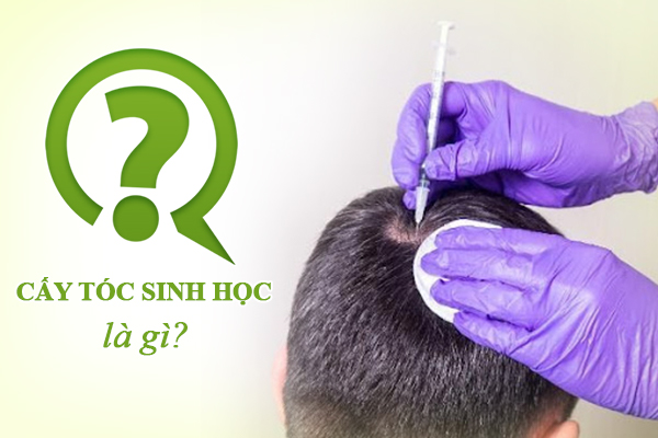 Cấy tóc sinh học là gì?