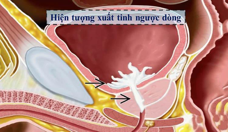 Sau phẫu thuật phì đại tuyến tiền liệt, nam giới có nguy cơ bị xuất tinh ngược dòng