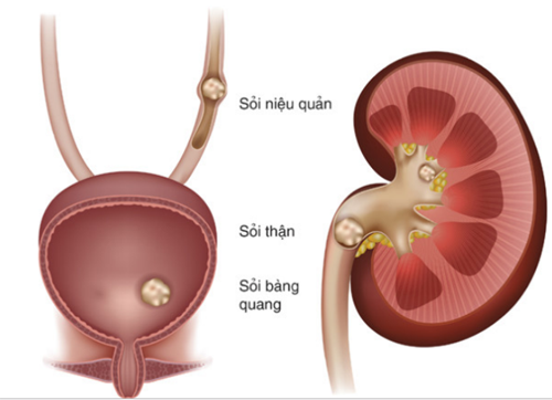 biến chứng phì đại tiền liệt tuyến