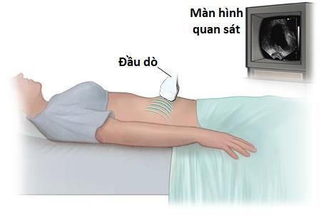 Siêu âm u xơ tiền liệt tuyến