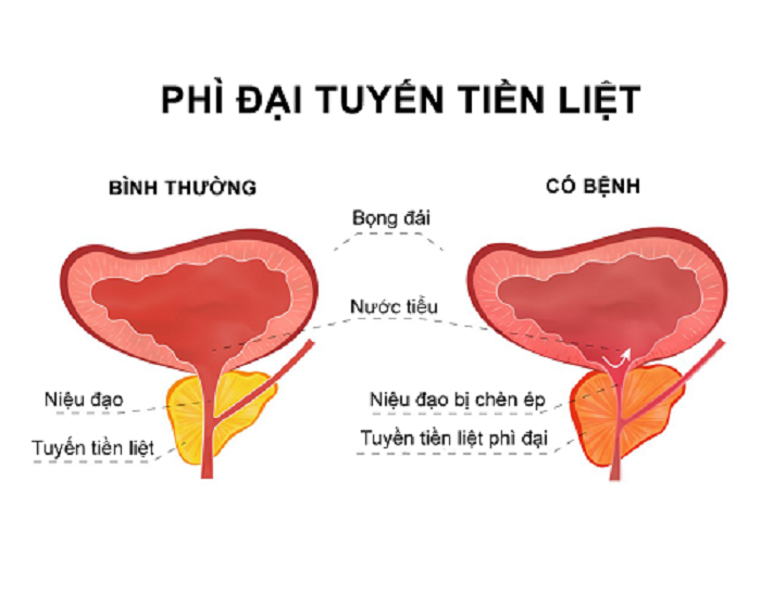 Phì đại tuyến tiền liệt là bệnh gì?