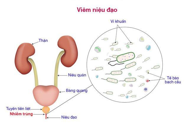 Viêm niệu đạo gây ra tình trạng tiểu buốt