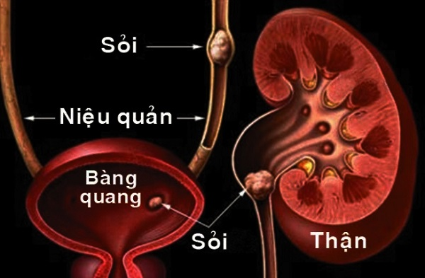 Sỏi niệu quản - Sỏi thận - Sỏi bàng quang đều gây tiểu nhiều lần