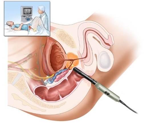 Kỹ thuật siêu âm tuyến tiền liệt qua trực tràng cho hình ảnh rõ nét