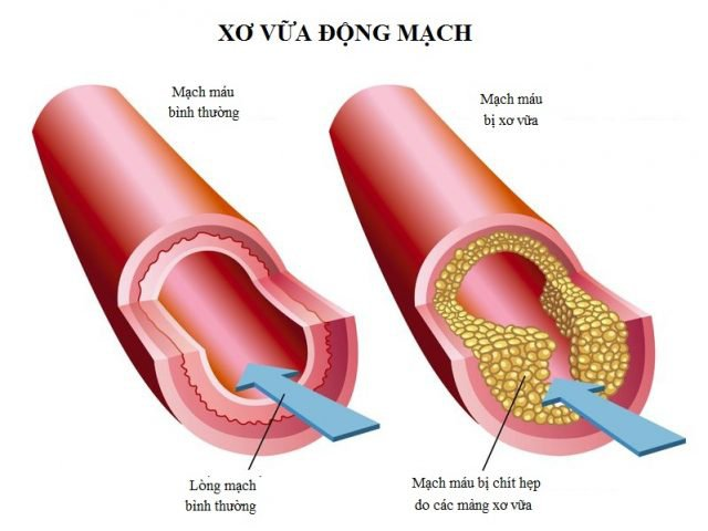 Rủi ro khi thực hiện nút mạch điều trị u xơ tuyến tiền liệt