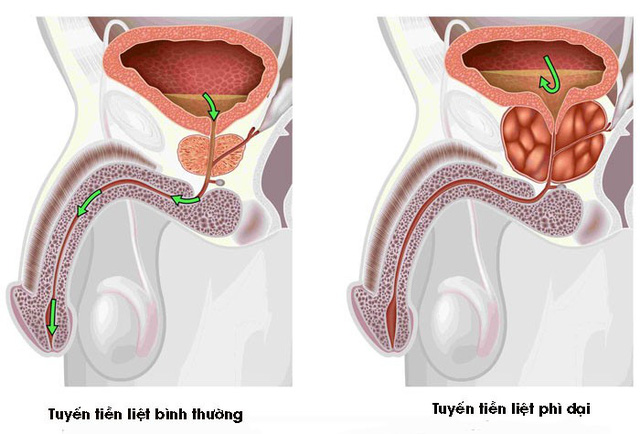 Bệnh u xơ tuyến tiền liệt có chữa khỏi được không?