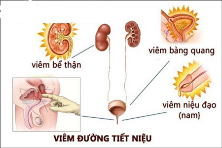 Biến chứng viêm đường tiết niệu