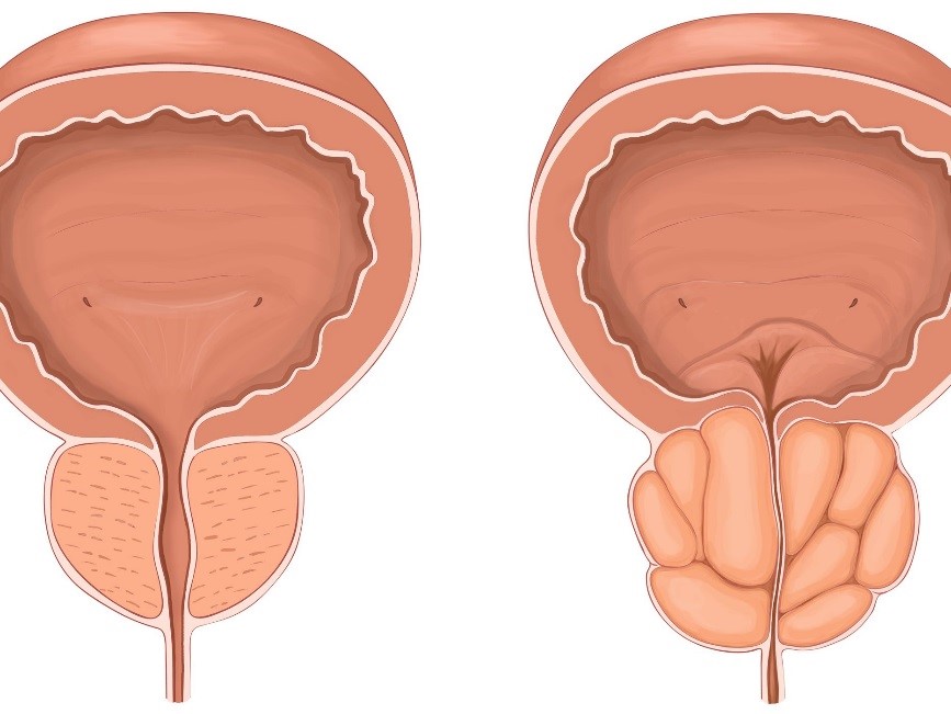 Kích thước phì đại tiền liệt tuyến