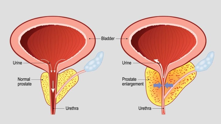 Phì đại tiền liệt tuyến là gì?