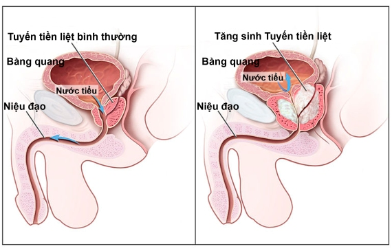 Tại sao bệnh u xơ tuyến tiền liệt gây tình trạng tiểu đêm mất ngủ?