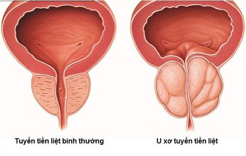 Tại sao bệnh u xơ tuyến tiền liệt gây tiểu rắt?