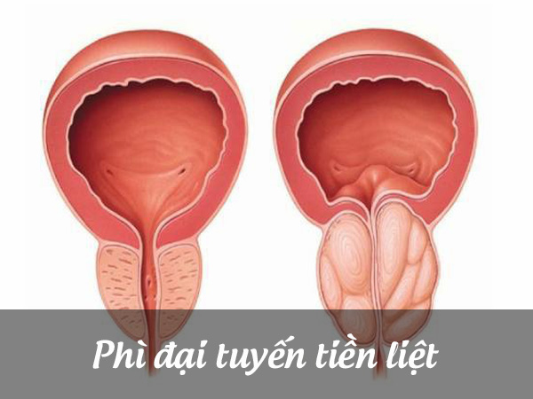 3 nguyên nhân gây phì đại tuyến tiền liệt và cách khắc phục hiệu quả