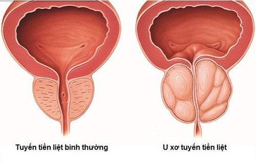 U xơ tuyến tiền liệt có mấy giai đoạn?