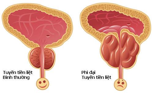 Phì đại tuyến tiền liệt là bệnh lý phổ biến gây ra tiểu đêm vào mùa đông