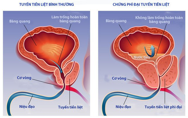 Tuyến tiền liệt phì đại kích thích bàng quang khiến người bệnh tiểu đêm nhiều lần