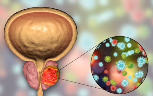 Biến chứng ung thư tuyến tiền liệt