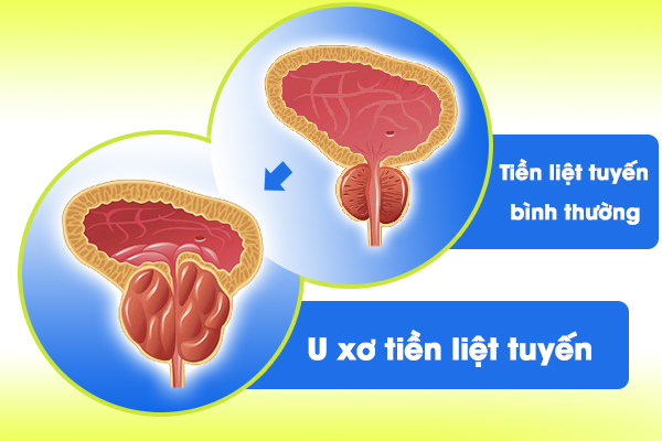 Phòng bệnh u xơ tiền liệt tuyến như thế nào?