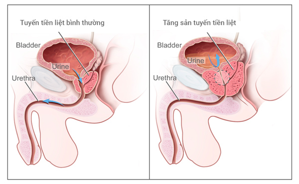 Nước tiểu đọng lại lâu ngày sẽ kéo theo nhiều biến chứng