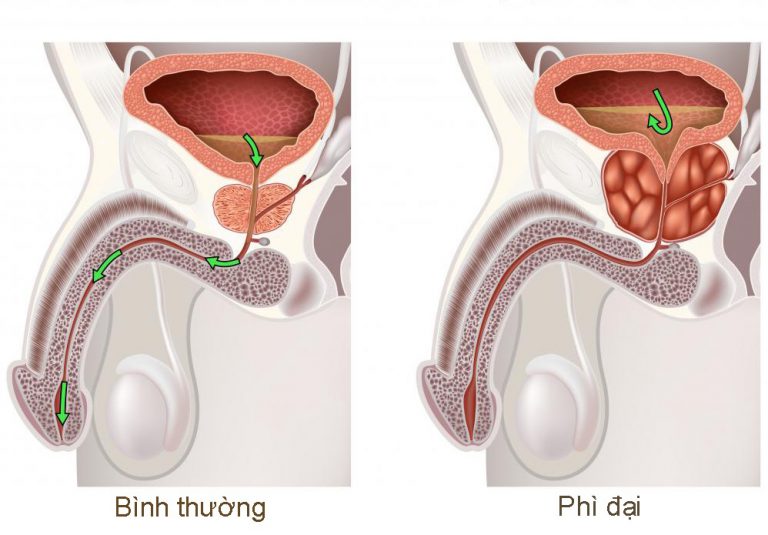 Triệu chứng phì đại tuyến tiền liệt và cách khắc phục với thảo dược