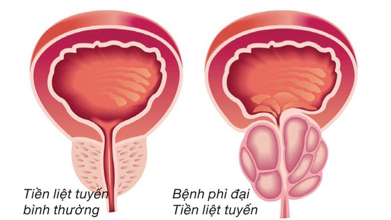 Có giảm được kích thước tuyến tiền liệt bị phì đại hay không ?