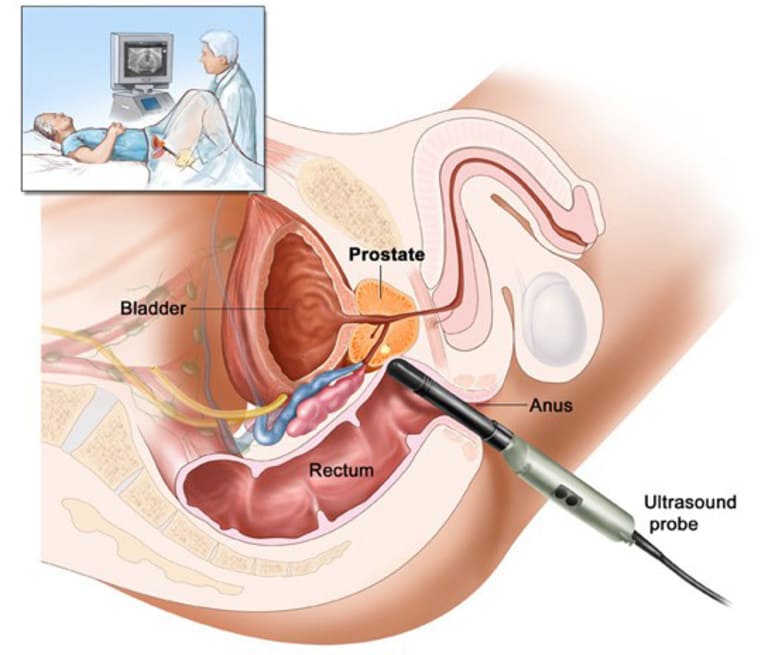 Siêu âm giúp phân biệt phì đại tuyến tiền liệt với các bệnh lý khác.