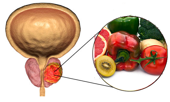 Phì đại tuyến tiền liệt kiêng ăn uống gì?