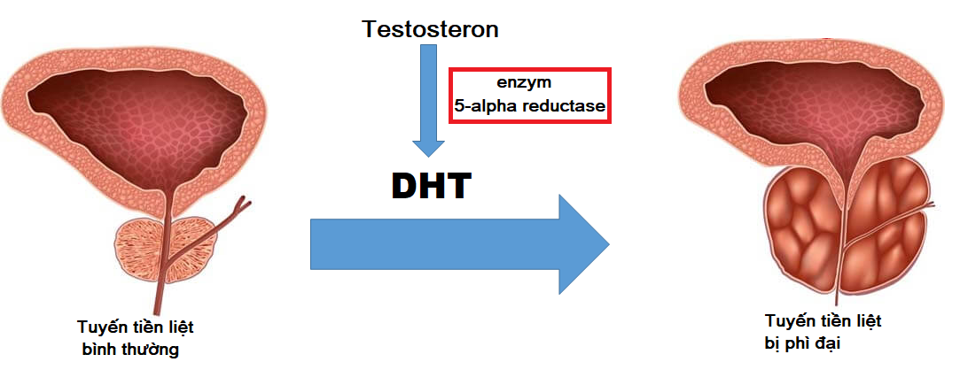 DHT là tác nhân gây tăng kích thước tuyến tiền liệt